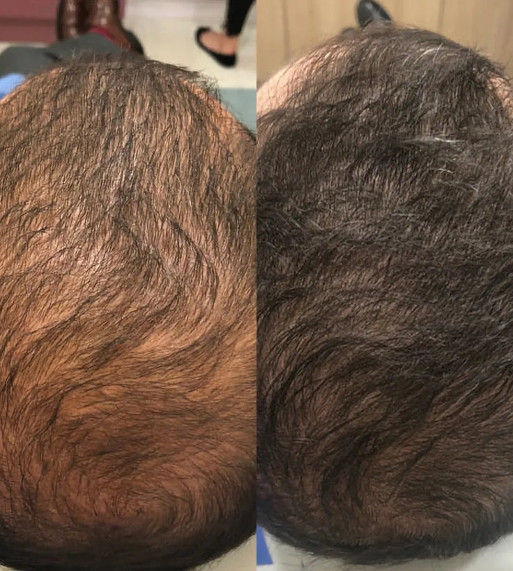 Spectral.DNC-N (Nanoxidil) lotion