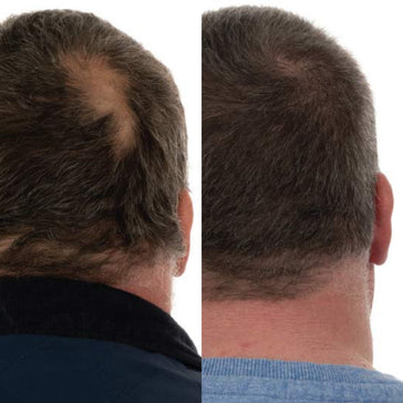 Foligain haargroei behandeling (man) Foligain haargroei behandeling (man)