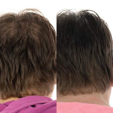 Foligain haargroei behandeling (vrouw) Foligain haargroei behandeling (vrouw)