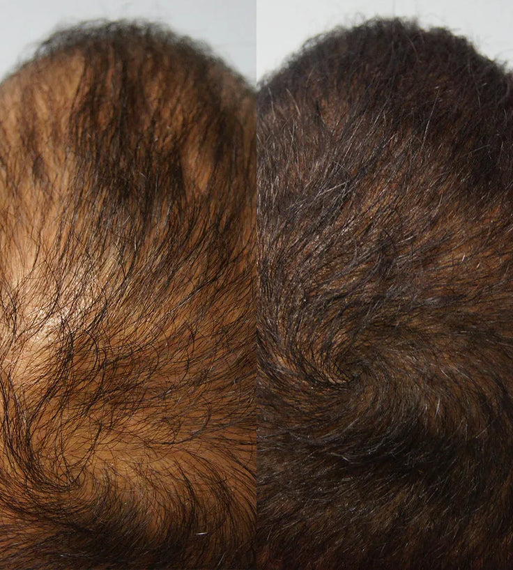 Kmax haaruitval follicle spray