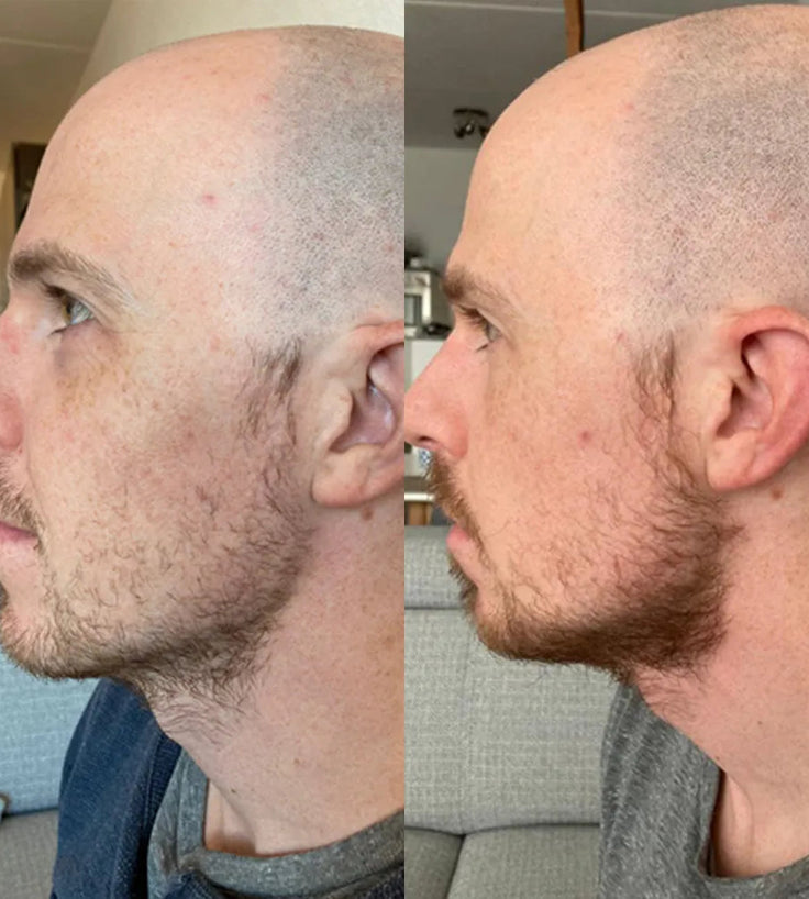 Neofollics Beard Growth Serum (7% Neoxyl)