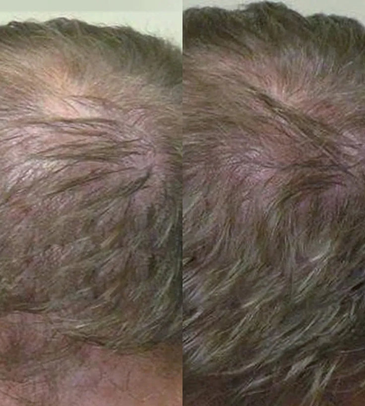 Neofollics Shampoo tegen haaruitval