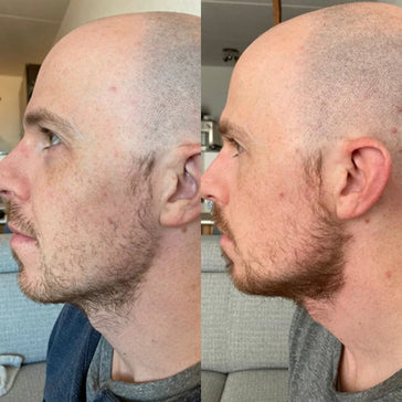 Neofollics beard growth serum Neofollics beard growth serum