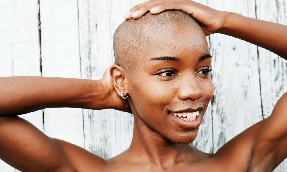 Alopecia areata
